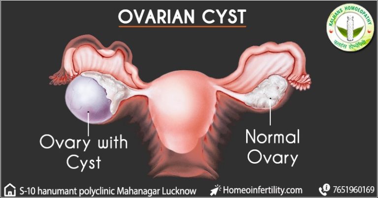 How To Get Pregnant With Ovarian Cysts Drrk Singhs Homoeopathic Infertility Center 2315